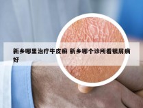 新乡哪里治疗牛皮癣 新乡哪个诊所看银屑病好