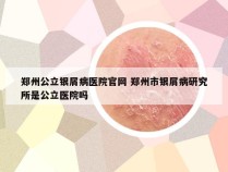 郑州公立银屑病医院官网 郑州市银屑病研究所是公立医院吗