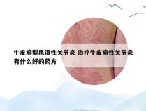 牛皮癣型风湿性关节炎 治疗牛皮癣性关节炎有什么好的药方