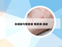 白胡椒与银屑病 银屑病 胡椒
