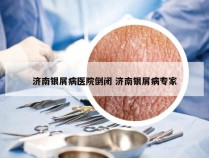 济南银屑病医院倒闭 济南银屑病专家