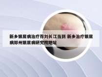 新乡银屑病治疗荐刘长江当到 新乡治疗银屑病郑州银屑病研究院地址