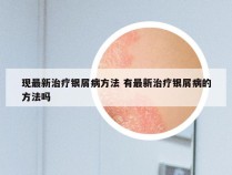 现最新治疗银屑病方法 有最新治疗银屑病的方法吗