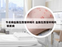 牛皮癣盐酸左西替利嗪片 盐酸左西替利嗪片 银屑病