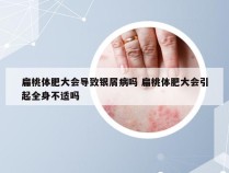 扁桃体肥大会导致银屑病吗 扁桃体肥大会引起全身不适吗