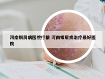 河南银屑病医院行情 河南银屑病治疗最好医院