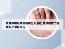 皮肤抓破后成银屑病怎么治疗 皮肤挠破了就成癣了涂什么药