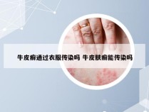 牛皮癣通过衣服传染吗 牛皮肤癣能传染吗