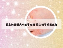 脸上长针眼大小的牛皮癣 脸上长牛癣怎么办
