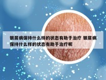 银屑病保持什么样的状态有助于治疗 银屑病保持什么样的状态有助于治疗呢
