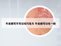 牛皮癣可不可以吃巧克力 牛皮癣可以吃一碗