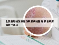 全国最好的治脓包性银屑病的医院 脓包银屑病用什么药
