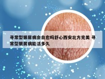 寻常型银屑病会自愈吗舒心西安北方完美 寻常型银屑病能活多久