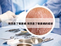 突然患了银屑病 突然患了银屑病的症状