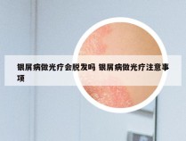 银屑病做光疗会脱发吗 银屑病做光疗注意事项