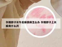 孕期脖子长牛皮癣很痒怎么办 孕期脖子上长癣用什么药