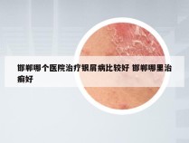 邯郸哪个医院治疗银屑病比较好 邯郸哪里治癣好
