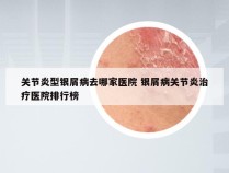 关节炎型银屑病去哪家医院 银屑病关节炎治疗医院排行榜