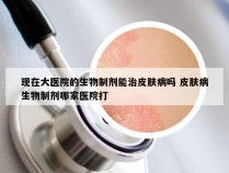 现在大医院的生物制剂能治皮肤病吗 皮肤病生物制剂哪家医院打