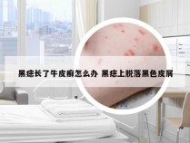 黑痣长了牛皮癣怎么办 黑痣上脱落黑色皮屑