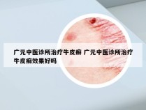 广元中医诊所治疗牛皮癣 广元中医诊所治疗牛皮癣效果好吗