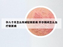 孕八个月怎么样减轻银屑病 怀孕期间怎么治疗银屑病