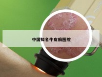 中国知名牛皮癣医院