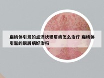 扁桃体引发的点滴状银屑病怎么治疗 扁桃体引起的银屑病好治吗