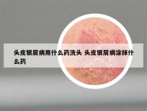 头皮银屑病用什么药洗头 头皮银屑病涂抹什么药