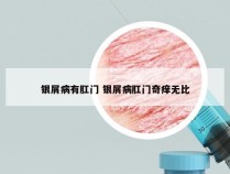 银屑病有肛门 银屑病肛门奇痒无比