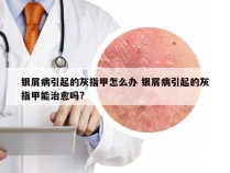 银屑病引起的灰指甲怎么办 银屑病引起的灰指甲能治愈吗?