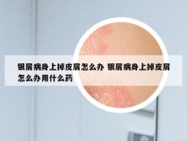 银屑病身上掉皮屑怎么办 银屑病身上掉皮屑怎么办用什么药