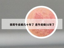 我哥牛皮癣几十年了 患牛皮癣31年了
