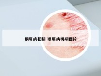 银屑病初期 银屑病初期图片