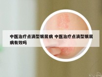 中医治疗点滴型银屑病 中医治疗点滴型银屑病有效吗