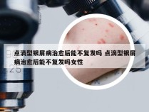 点滴型银屑病治愈后能不复发吗 点滴型银屑病治愈后能不复发吗女性