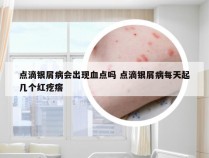 点滴银屑病会出现血点吗 点滴银屑病每天起几个红疙瘩