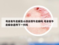 母亲有牛皮癣生小孩会得牛皮癣吗 母亲有牛皮癣会遗传下一代吗
