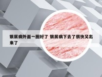 银屑病外面一圈好了 银屑病下去了很快又出来了