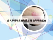 空气干燥牛皮癣加重原因 空气干燥起皮
