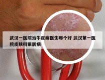 武汉一医院治牛皮癣医生哪个好 武汉第一医院皮肤科银屑病