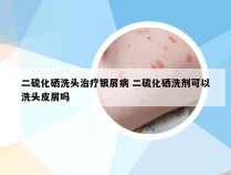 二硫化硒洗头治疗银屑病 二硫化硒洗剂可以洗头皮屑吗