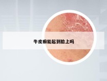 牛皮癣能起到脸上吗