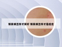 银屑病怎样才算好 银屑病怎样才是痊愈