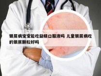 银屑病宝宝能吃益精口服液吗 儿童银屑病吃的银屑颗粒好吗