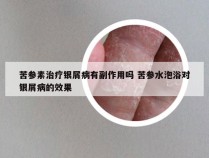 苦参素治疗银屑病有副作用吗 苦参水泡浴对银屑病的效果