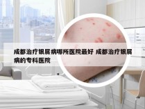 成都治疗银屑病哪所医院最好 成都治疗银屑病的专科医院