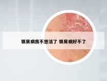 银屑病我不想活了 银屑病好不了