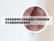 寻常型银屑病可以买重疾险吗 寻常型银屑病可以买重疾险吗能报销吗