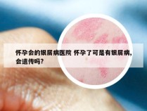 怀孕会的银屑病医院 怀孕了可是有银屑病,会遗传吗?